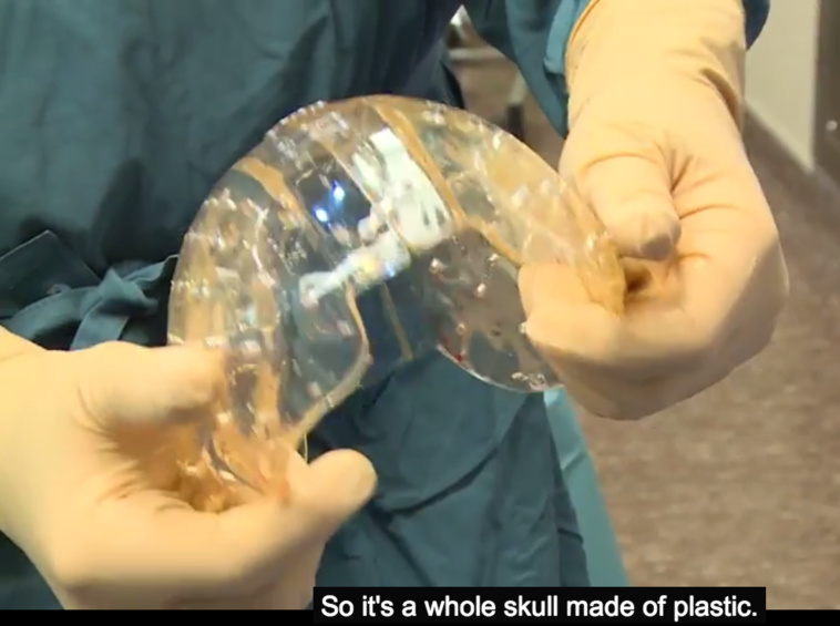 Une transplantation crânienne a été effectuée grâce à une imprimante 3D